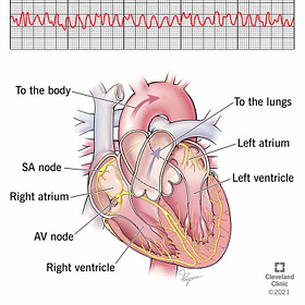 Atrial Fibrillation is the most common type of Tachycardia, Anaphylaxis leading to Sudden Death caused by Endotoxin in mRNA Jabs