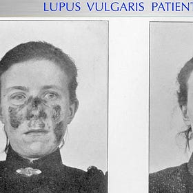 How Sunlight Heals Skin Disease