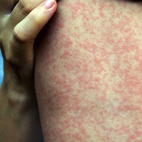 Measles is not a harmless illness — complications include brain damage, immune amnesia, and death