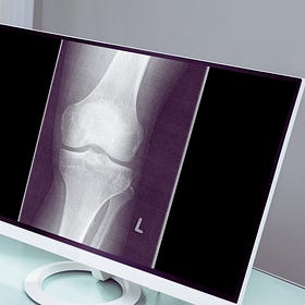 IIT Guwahati Researchers Develops AI Model to Assess Knee Osteoarthritis Severity from X-ray Images