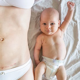 5 myths about caesareans everyone needs to stop believing