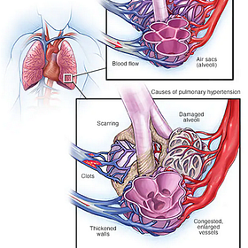 Endotoxin in Jabs causes Pulmonary Hypertension