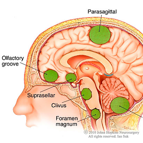 Meningiomas from Progesterone Injections containing Endotoxin