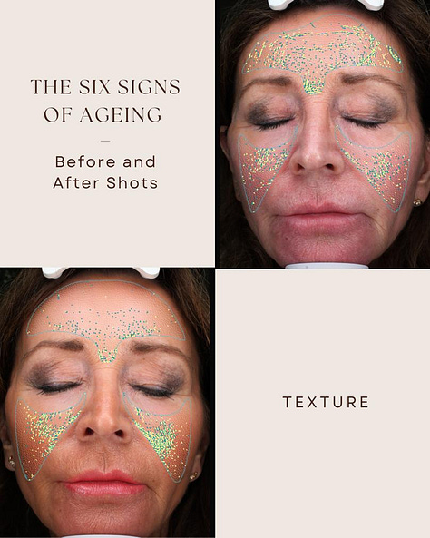 The Rejuvenator facial targets fine lines and open pores, reduces sun spots, red spots, brown spots, and improves a smoother more even texture.