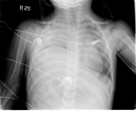 Elevated right hemidiaphragm with herniation of liver into thoracic cavity