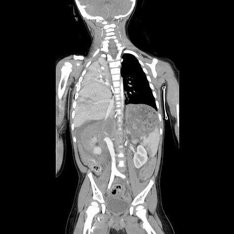 Elevated right hemidiaphragm with herniation of liver into thoracic cavity