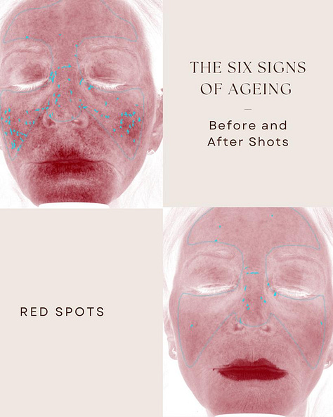 The Rejuvenator facial targets fine lines and open pores, reduces sun spots, red spots, brown spots, and improves a smoother more even texture.