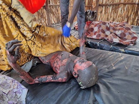 Burn victims in Nasir, March 16, 2025