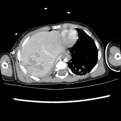 Elevated right hemidiaphragm with herniation of liver into thoracic cavity