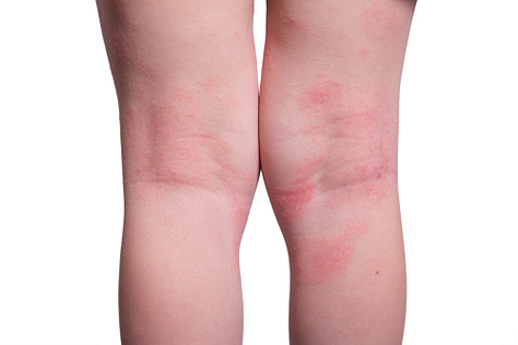 scabies vs eczema