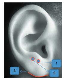 Psychic areas of earlobe