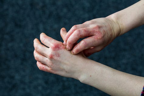 scabies vs eczema