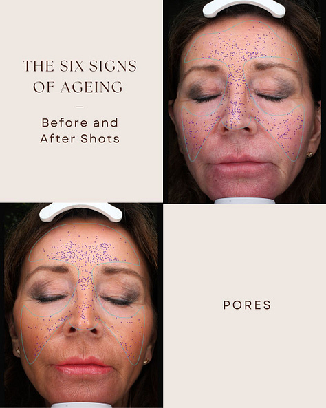 The Rejuvenator facial targets fine lines and open pores, reduces sun spots, red spots, brown spots, and improves a smoother more even texture.