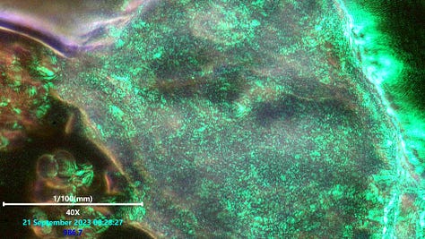 Scanning laser microscopy of polymerized structure in blood showing wavy pattern phenomena.