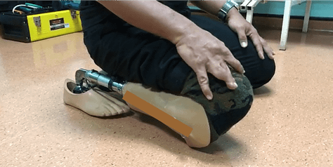 MyB Prosthetic Limb