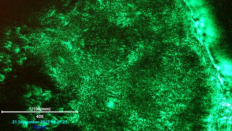 Scanning laser microscopy of polymerized structure in blood showing wavy pattern phenomena.