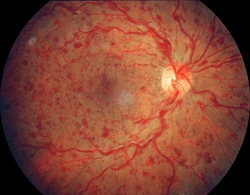 Central Retinal Vein Occlusion