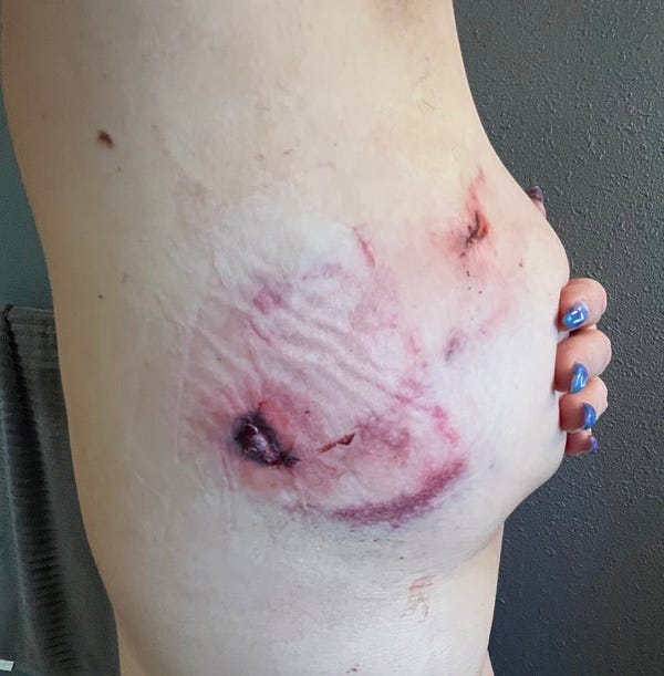 A woman stands with a camera facing her right side. Her right breast is visible and partially covered with her hand. There are two holes which appear to be the entrance and exit of a bullet wound. All around it is bruised and swollen tissue