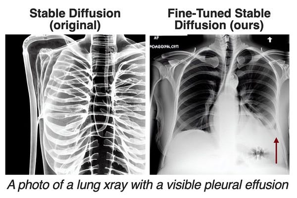 Original and refined synthetic CXR for the prompt "A photo of a lung xray with a visible pleural effusion".