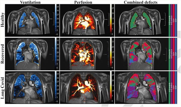 Images of lungs showing the measure of air and blood flow in the lungs (V/Q match) was reduced from 81% in healthy controls to 62% in the recovered group and 60% in the Long COVID group.