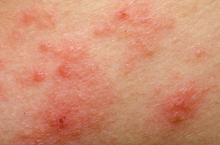 scabies vs eczema