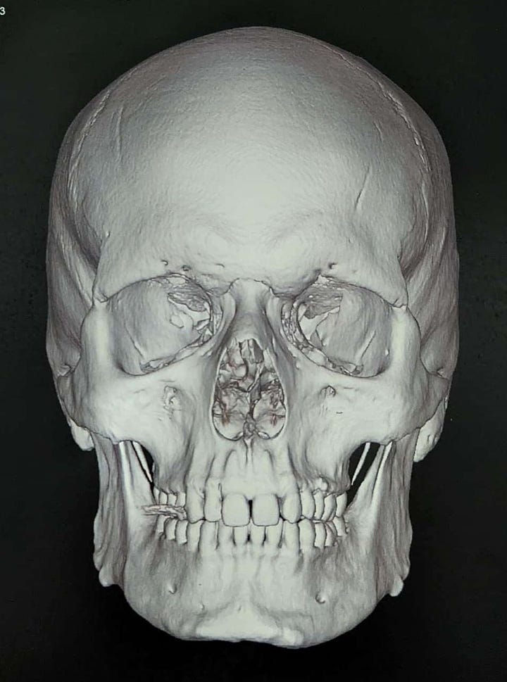 Two CT scans of Doc Impossibles skull. One is in profile, the other in portrait. The eye sockets droop heavily, and the brow ridge is very pronounced.