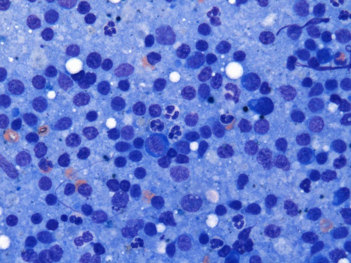 Left: Max's lymph node cytology; Right: Classic large cell lymphoma