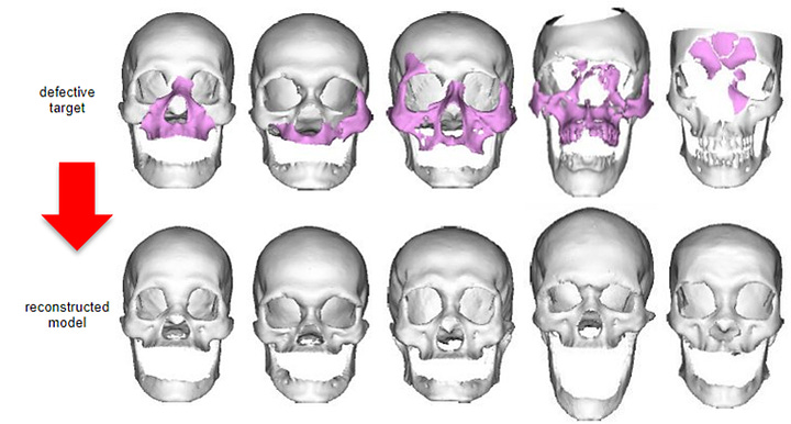 Rebuild, Restore, Reconstruct – An Improved Method For Craniomaxillo Facial Surgery