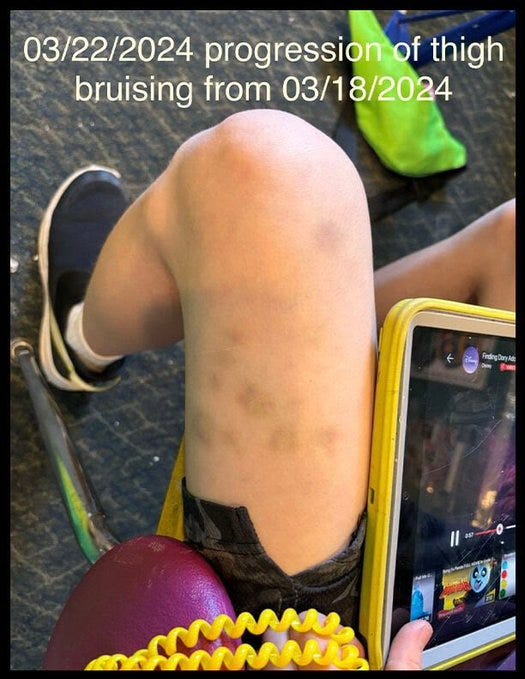 Photos of Childs Injuries