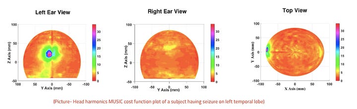 Non-invasive, Time Efficient and Patient Friendly Diagnostic Tool for Epileptogenic Zone Detection