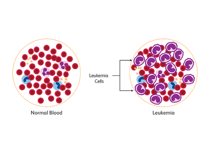 How does leukemia start?