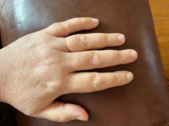 Wedding rings and swollen hand