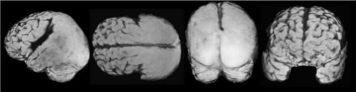 Inventions Uncover Genetics and Mechanisms Underlying Brain Developmental Disorders