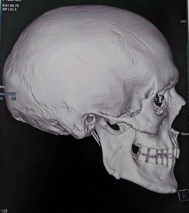 Two CT scans of Doc Impossibles skull. One is in profile, the other in portrait. The eye sockets droop heavily, and the brow ridge is very pronounced.