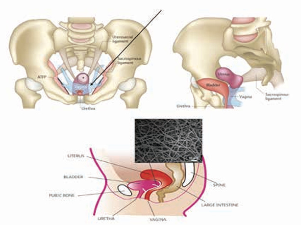 Mesh for Pelvic Organ Prolapse