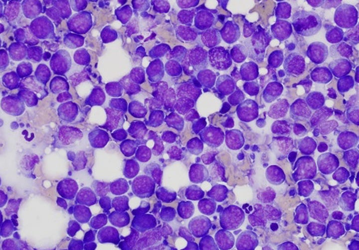 Left: Max's lymph node cytology; Right: Classic large cell lymphoma