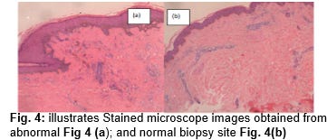 Transdermal Collagen and Hemoglobin Sensor