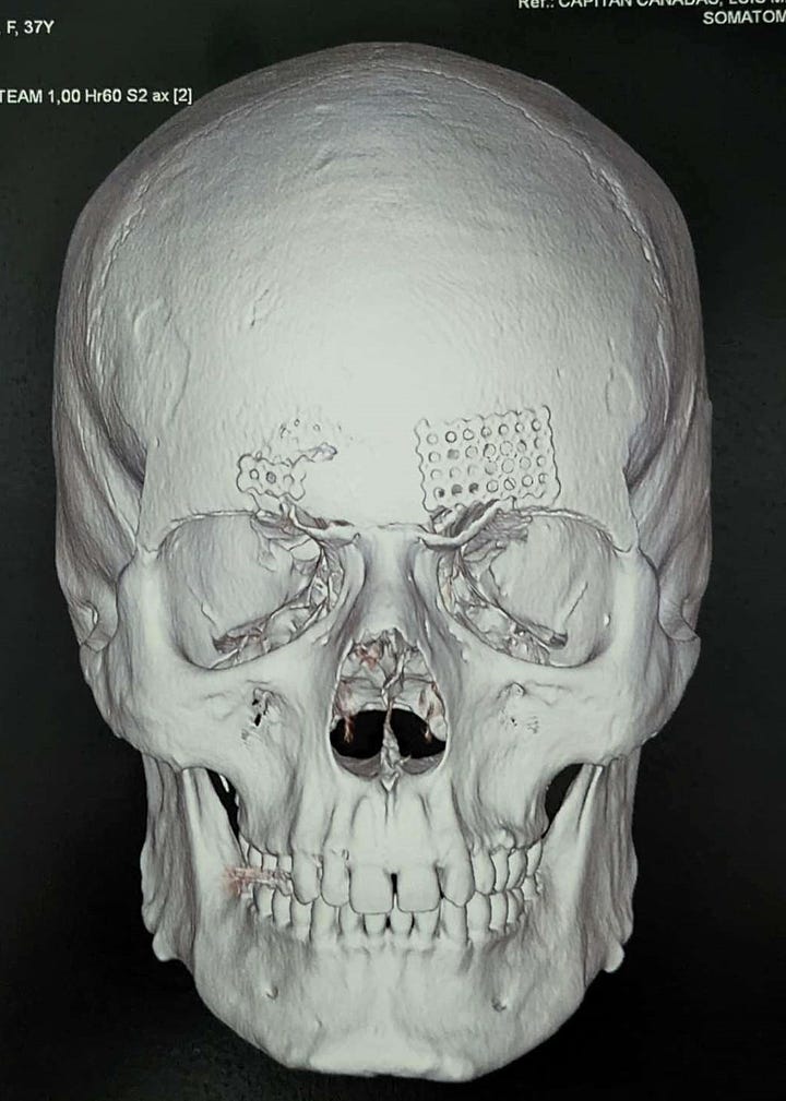 Two CT scans, in profile and portrait, of Doc Impossible's skull. Her brow ridge is completely gone, and the eye sockets are open and normal. 