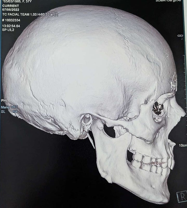 Two CT scans, in profile and portrait, of Doc Impossible's skull. Her brow ridge is completely gone, and the eye sockets are open and normal. 