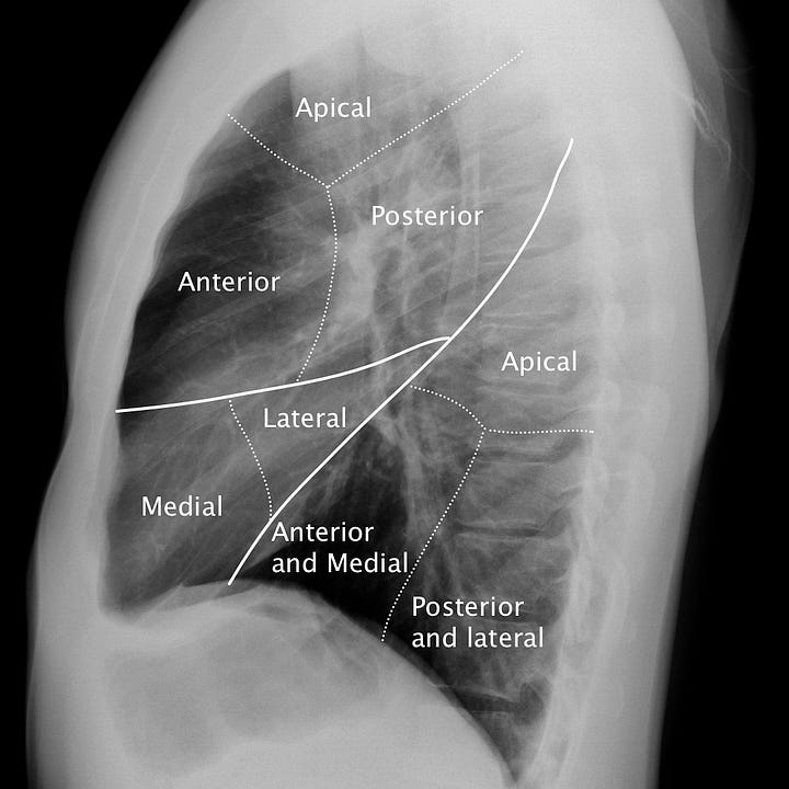 Chest anatomy - radiographs and CT - by Alexander Baxter