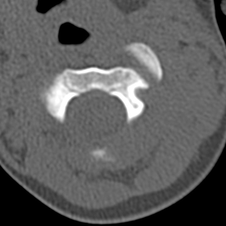 Atlantoaxial rotatory subluxation - by Alexander Baxter