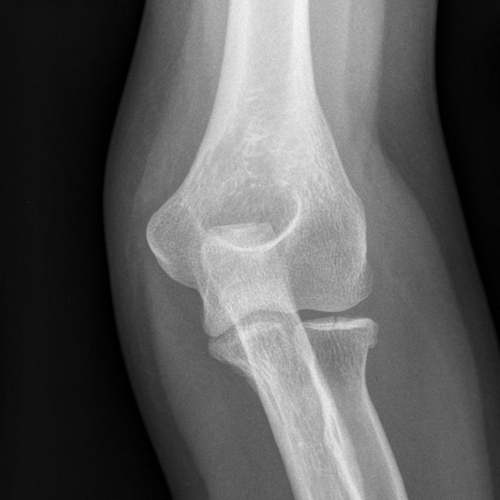 Radial head fracture and EssexLopresti fracture dislocation