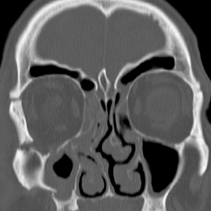 Complex Fracture by Alexander Baxter