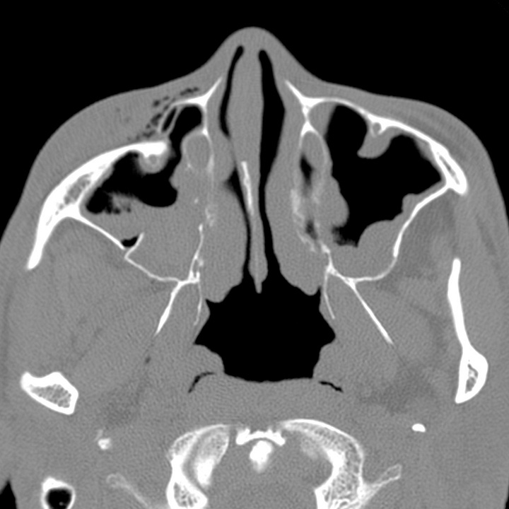 Complex Fracture RadNotes