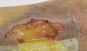 Transición de fase — cuando hay que bajar la capacidad del apósito