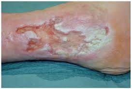 Borde blanco macerado — piel perilesional comprometida