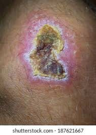 Herida con costra seca — ejemplo de desecación