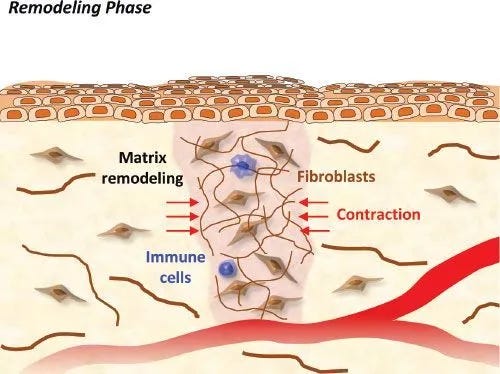 Cicatriz en fase de remodelación