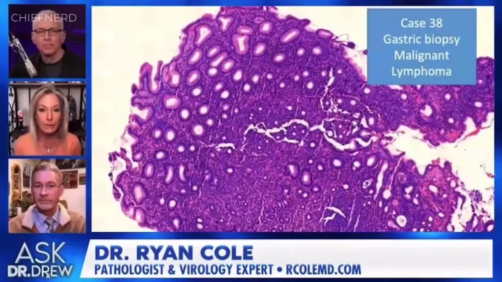 Dr. Ryan Cole's Claim Of Spike Protein "...Inside Every Cancer Cell"