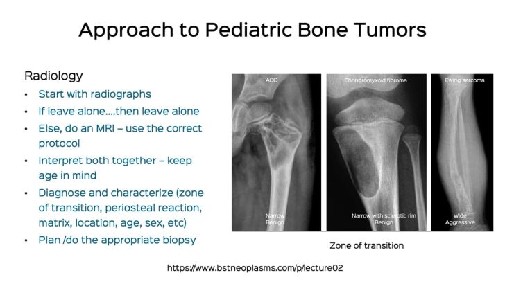 Lecture 2A: Approach to Pediatric Bone Tumors - ISPR - Sep 2023
